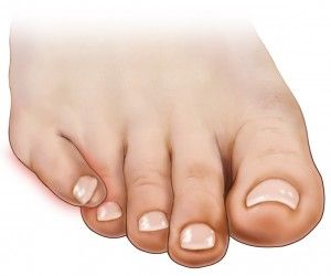 Overlapping Toes: Causes and Treatment for Adults and Newborns