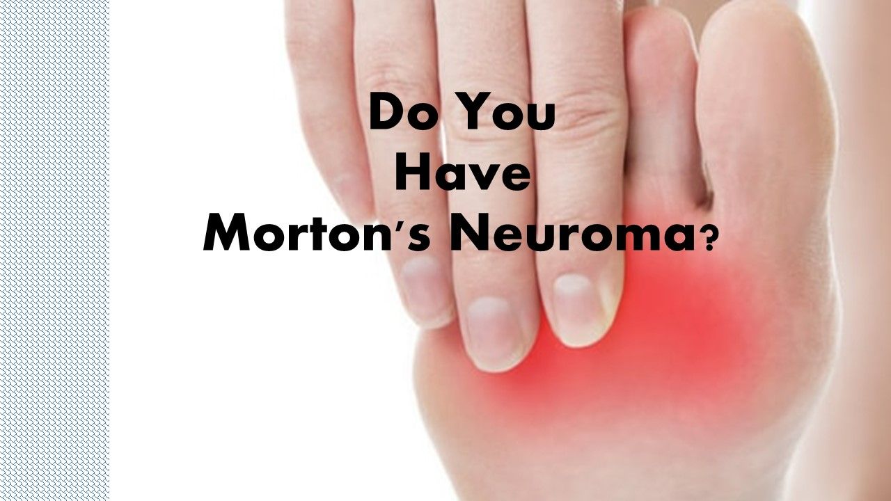 Ask the doctors: Having a Morton’s neuroma is a pain in the foot