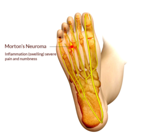 Launch of Informational Page on Morton's Neuroma and Shoe Insoles Anno