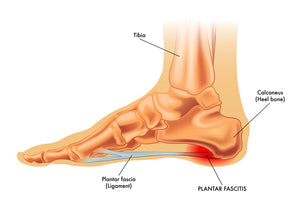 The 6 crucial elements for beating Plantar Fasciitis